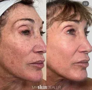 Local Guide to Best Estheticians in Boca & Delray
